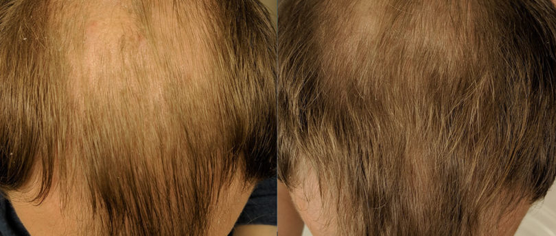 массаж кожи головы для роста волос